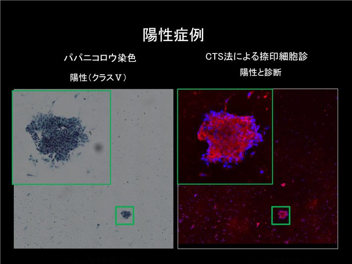 図1 陽性（乳がん）症例におけるCTS法による捺印細胞診の蛍光画像とパパニコロウ染色による細胞像 