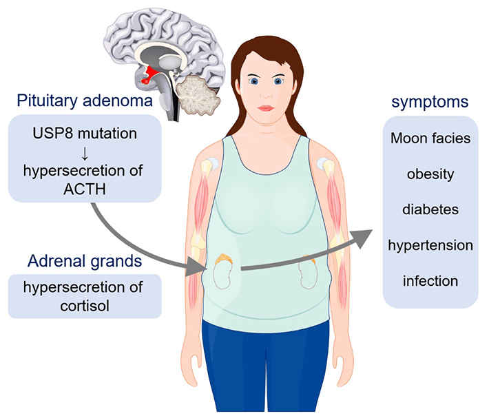 Figure 1 Signs and symptoms of Cushing's disease Mutations of the enzyme ubiquitin-specific protease 8 (USP8) in pituitary adenoma cause excess secretion of the adrenocorticotropic hormone (ACTH) that stimulates cortisol production—the hallmark of Cushing's disease. This affects major organs and tissues in the body, and can have serious complications if left untreated. Little is known about the details of the effects of these mutations on USP8 function. Researchers from Tokyo Tech in Japan have now implicated the dysregulation of USP8 in Cushing’s disease pathogenesis.  Copyright: [designua] © 123RF.com