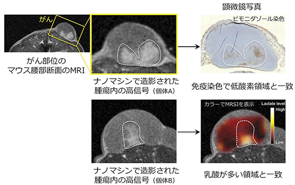 ナノマシン造影剤はMRIでがんを検出するだけでなく、その内部構造や悪性度の診断にも役立つ可能性があります。ナノマシン造影剤はがん組織の中でも、特に悪性度の高いとされる低い酸素濃度や低pHの領域で信号が上がり白くなりました。この効果は安価な低磁場MRIでより強くなるため、臨床現場に存在するMRI装置が活用でき、がんの悪性度や治療抵抗性の診断に役立つと考えられます。