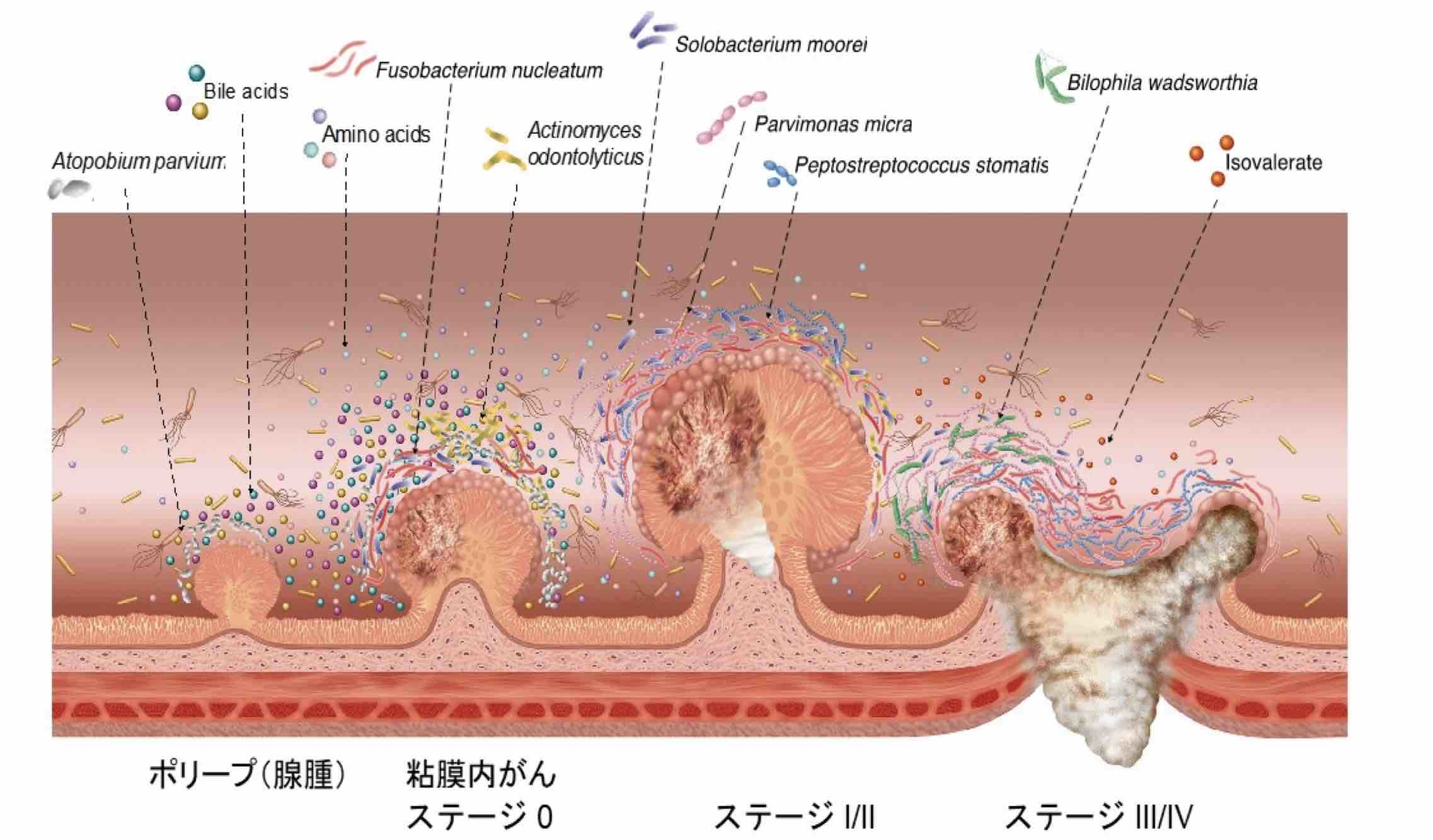 がんの多段階発がんと腸内環境の変動