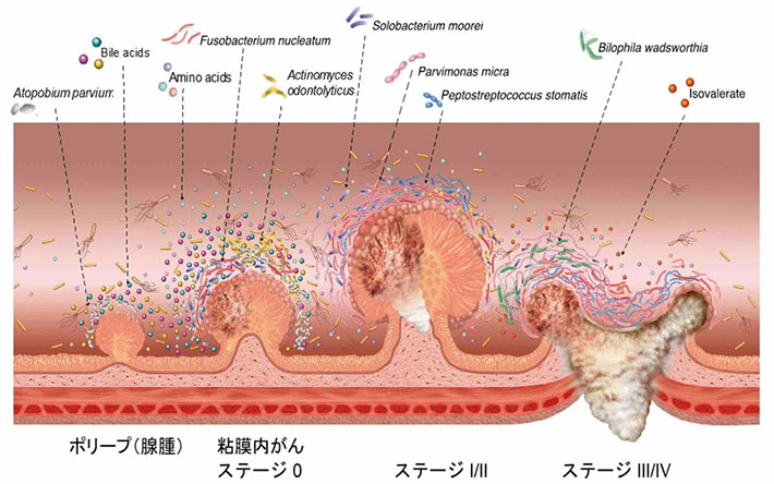 がんの多段階発がんと腸内環境の変動